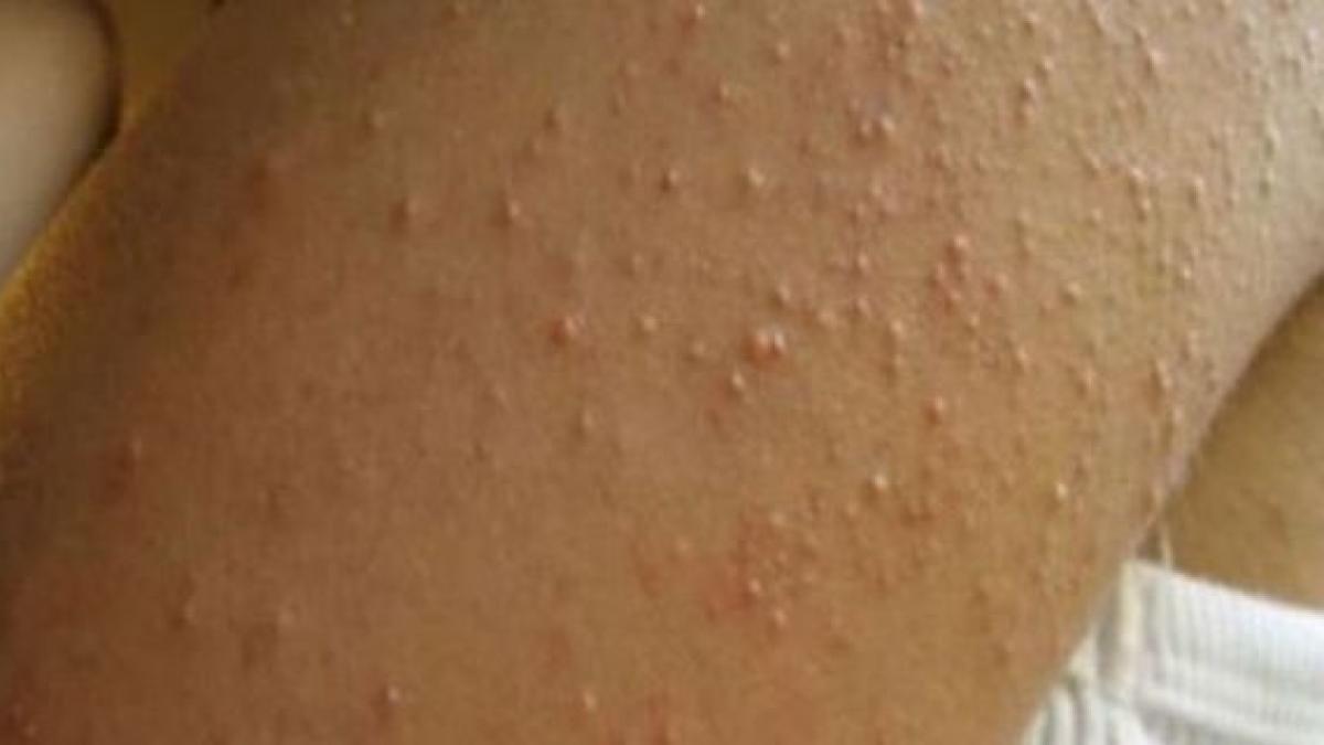 ai aceste cosuri mici pe corp mergi urgent la medic de ce sunt atat de periculoase