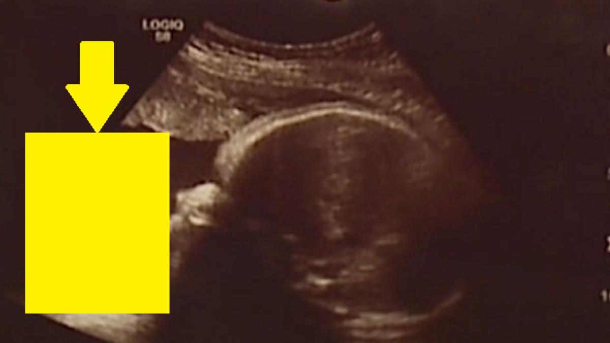 au mers la medic sa si vada bebelusul insa au plecat extrem de tulburati de acolo ce aparea in