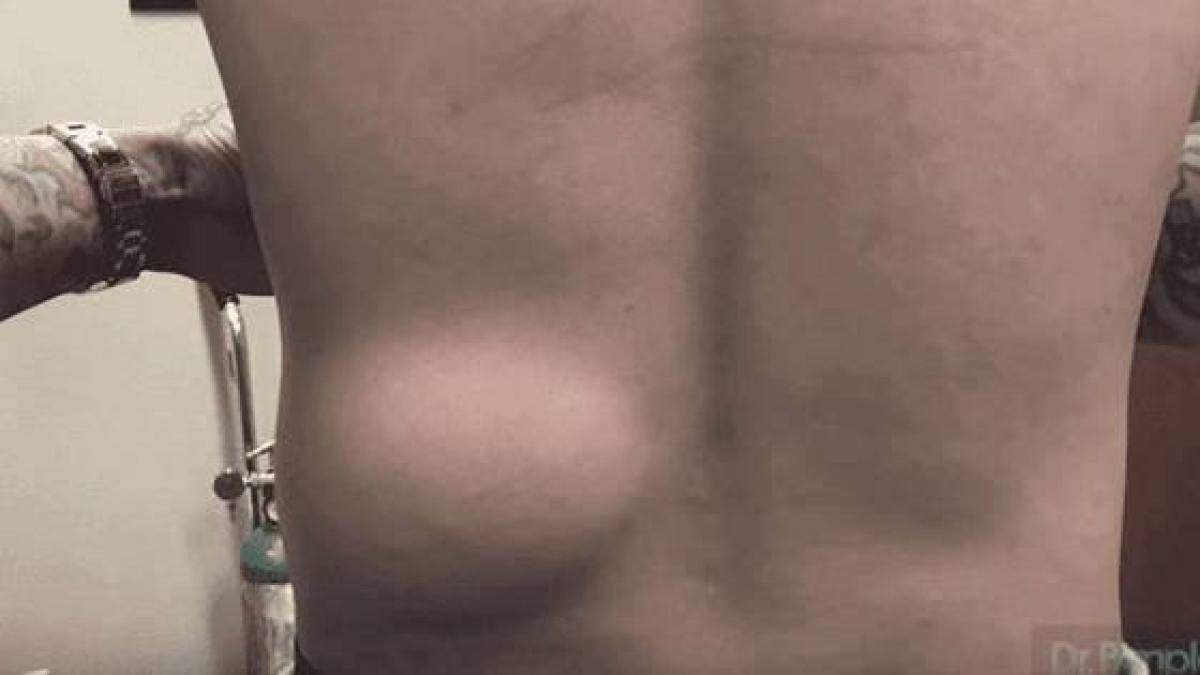 a ani la rand cu o umflatura uriasa pe spate dar si a facut pana la urma curaj sa mearga la medic