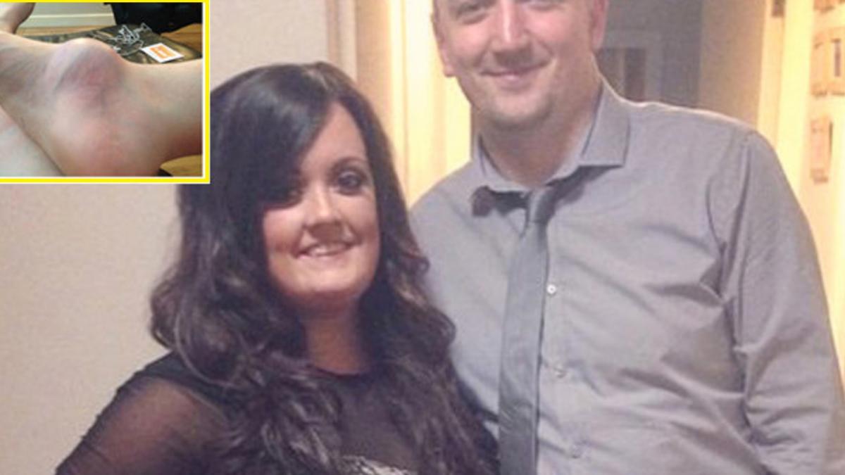 a observat ca are o galma uriasa pe picior si a ignorat o ani de zile cand iubitul a dus o cu forta