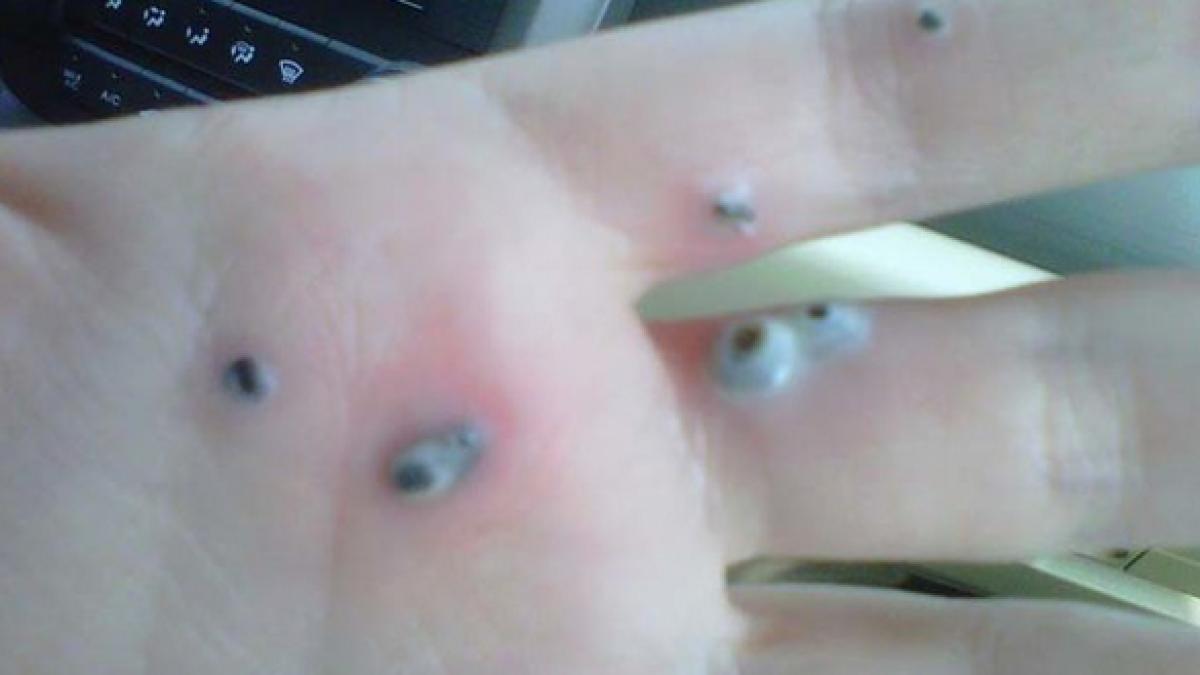 sotiei ii aparusera puncte argintii pe mana cresteau din ce in ce mai mari si din ele iesea ceva