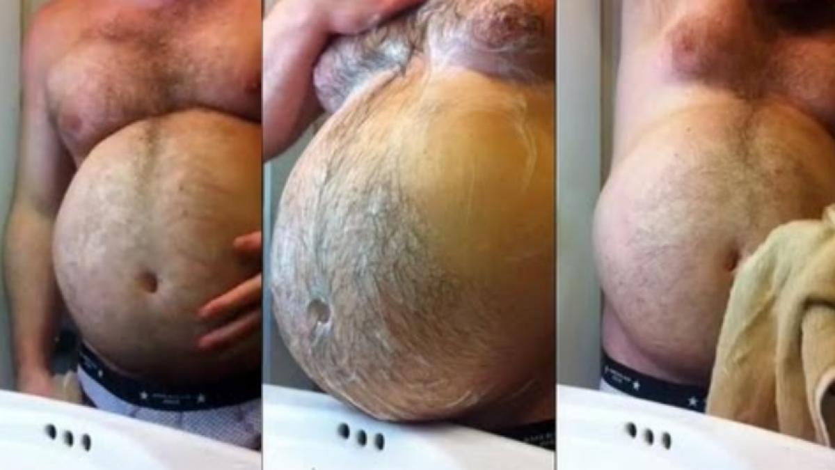 barbatul a ajuns la spital cu o burta uriasa si dureri crunte cand medici au vazut ce avea in ea s