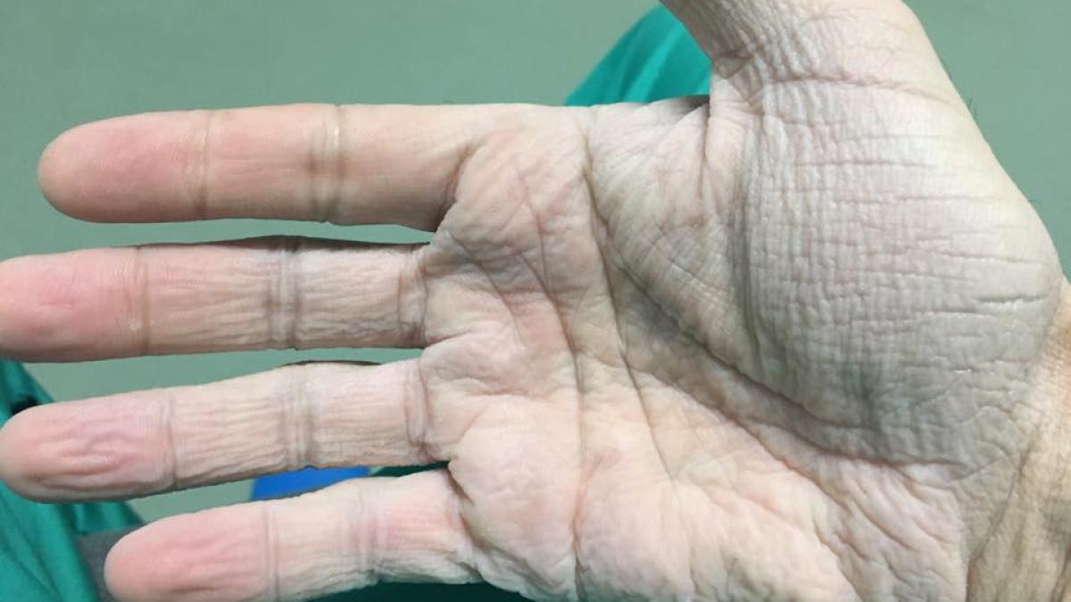 cum arata mana unui medic din romania dupa 12 ore de operatii la 30 de grade a ajuns o batjocura sa