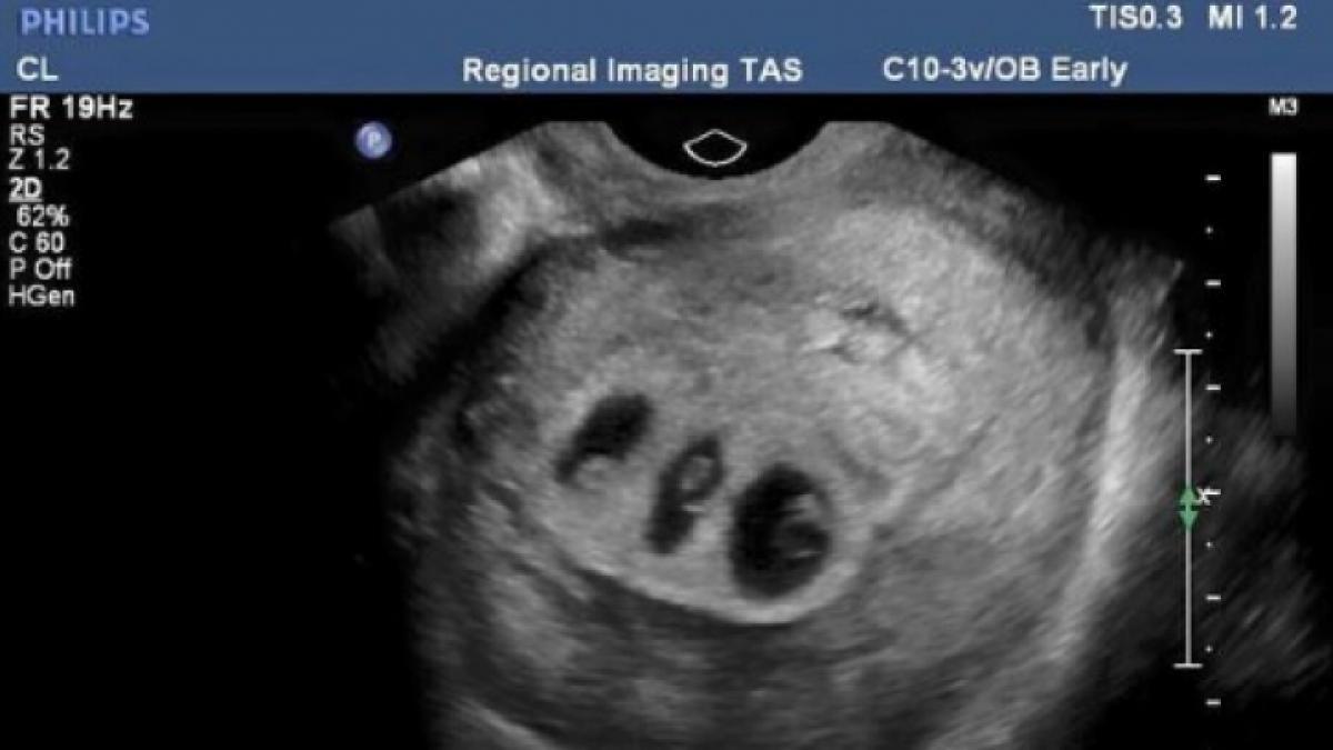 doctorii i au spus sa aleaga care dintre cei trei bebelusi va trai decizia ei a socat o lume