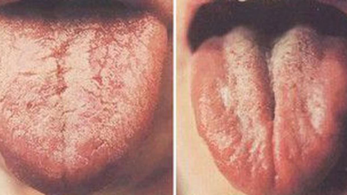 ai asa ceva pe limba poti sa fii grav bolnav mergi urgent la medic