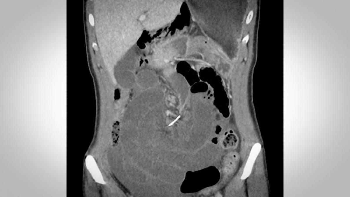 avea dureri cumplite de stomac asa ca s a dus la spital cand au vazut ce a iesit la rmn medicii au