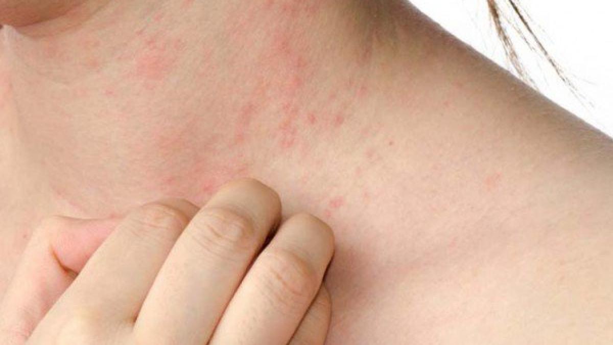 suferea mereu de eczeme si nu reusea deloc sa scape de aceasta problema deranjanta a incearcat