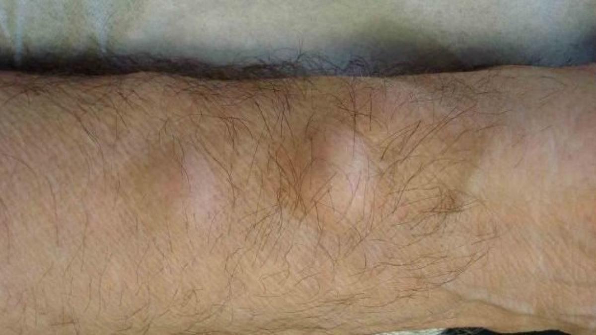 avea doua umflaturi pe mana dreapta toata lumea il ocolea cand purta tricouri ce a decis sa faca