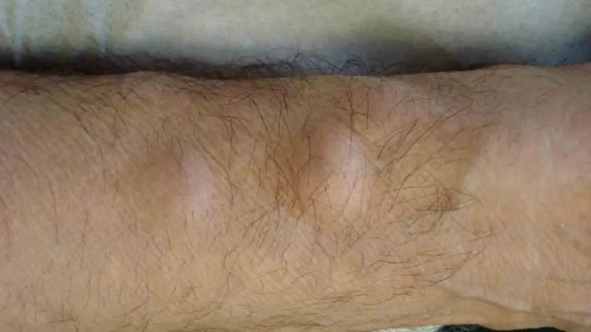 avea doua umflaturi pe mana dreapta toata lumea il ocolea cand purta tricouri ce a decis sa faca