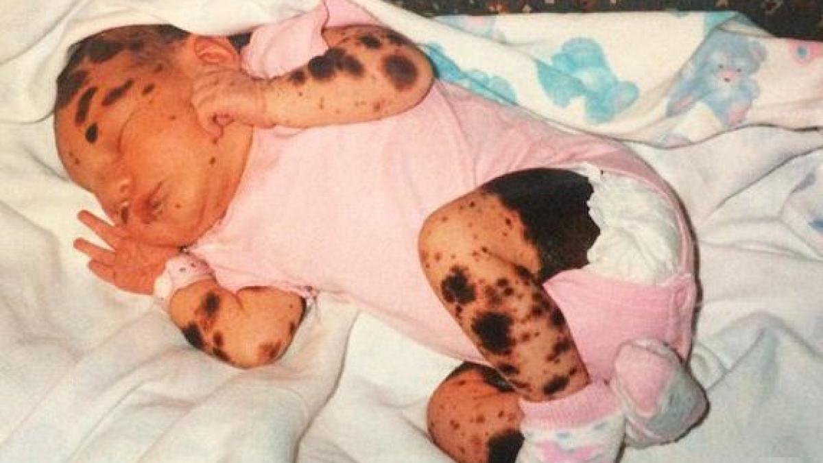 s a nascut cu o boala rara de piele si i se spunea dalmatianca cum arata tanara astazi la 20 ani