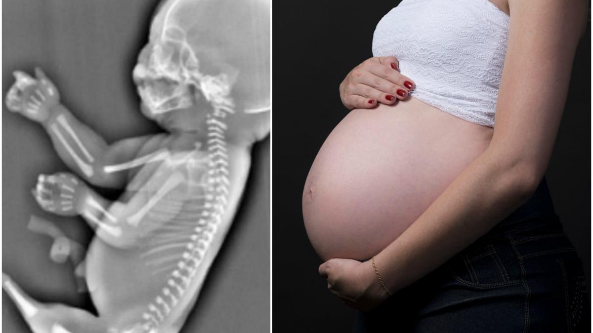o tanara a aflat la ecografie ca bebelusul ei are o coada in loc de picioare ce decizie a luat