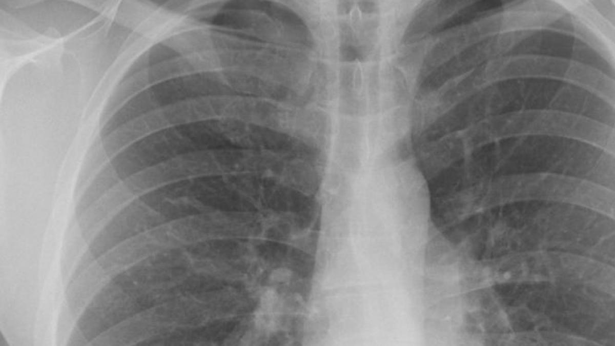 singurul semn care anunta cancerul pulmonar