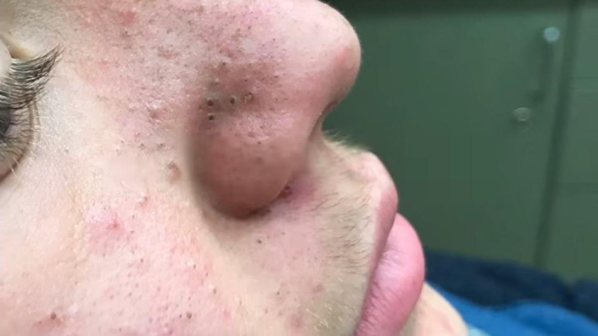 tanarul acesta a mers la medic pentru ca nu mai reusea sa scape de punctele negre de pe fata e