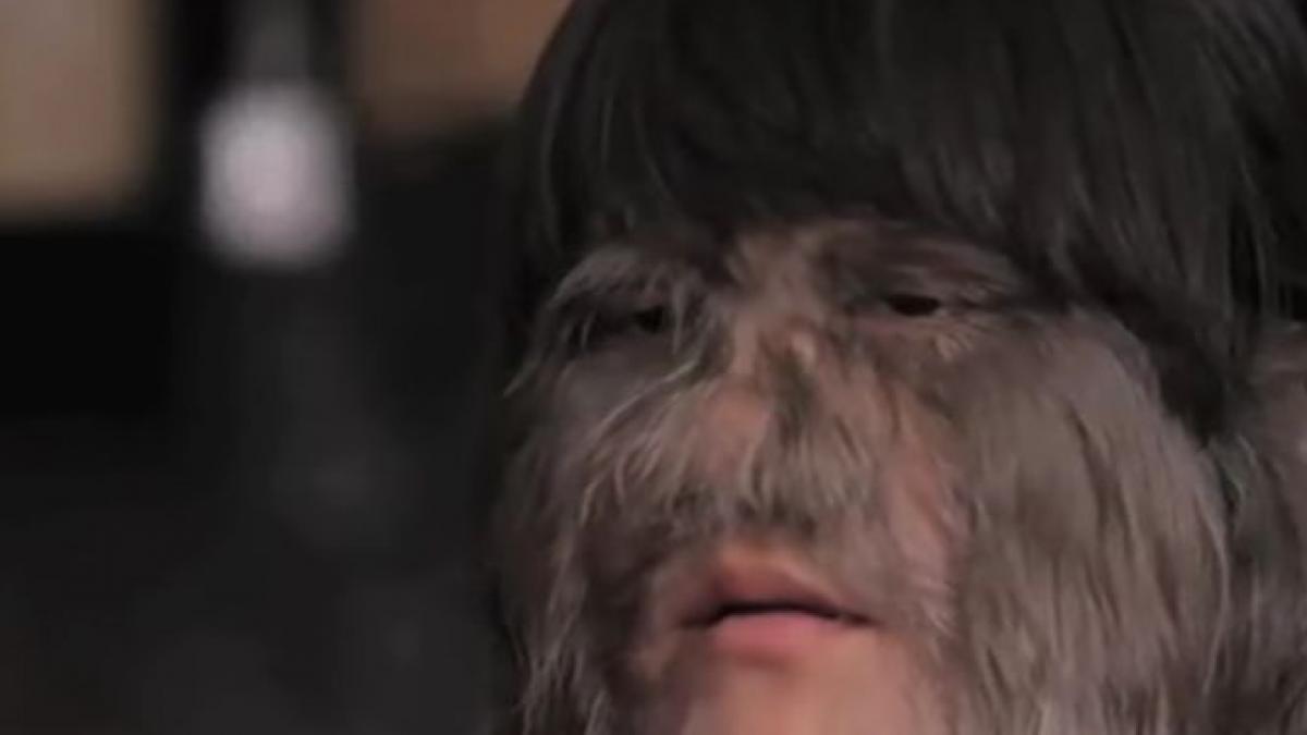 cea mai paroasa fata din lume si a gasit sufletul pereche si a ras tot parul de pe fata dupa ce s a