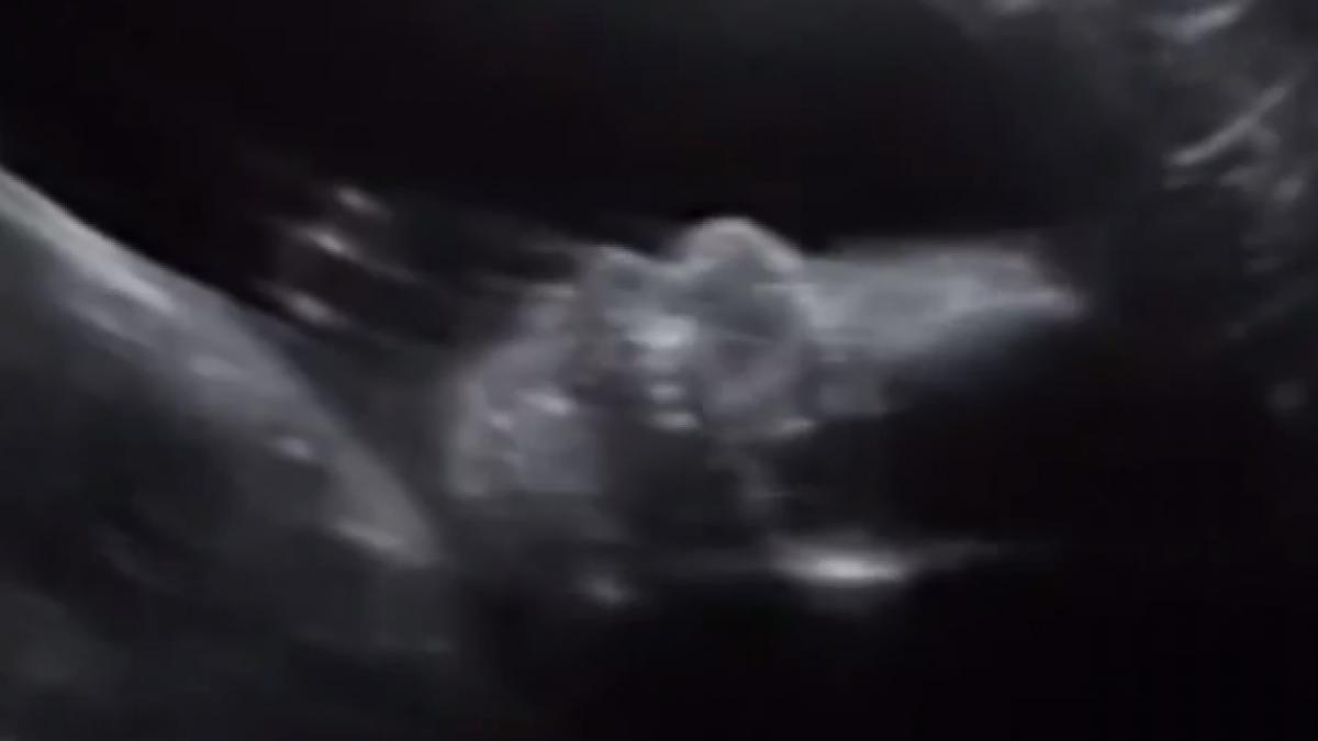 se uitau pe ecografia bebelusui lor cand au surprins ceva incredibil copilul s a intors spre