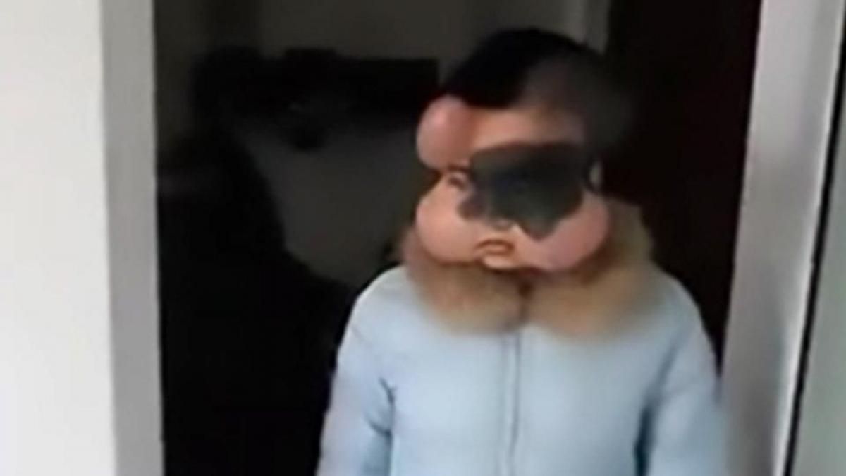 prietenii radeau de ea fiindca avea fata deformata ceea ce nu stiau e ca tanara suferea de o boala