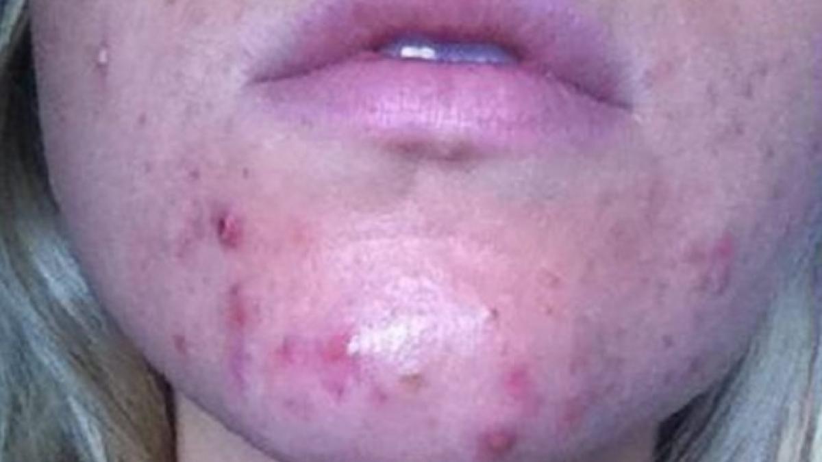 boala psihica de care este posibil sa sufere persoanele cu acnee pe fata ce recomanda medicii
