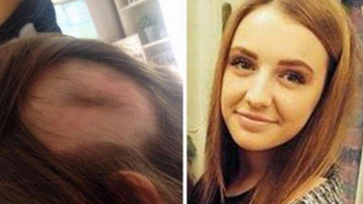 afectiunea de care sufera o tanara careia i a cazut tot parul la doar 19 ani