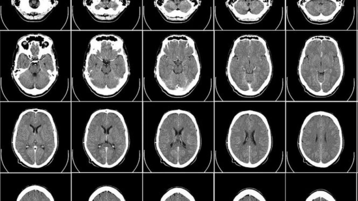 ce se intampla in creierul nostru dupa varsta de 13 ani