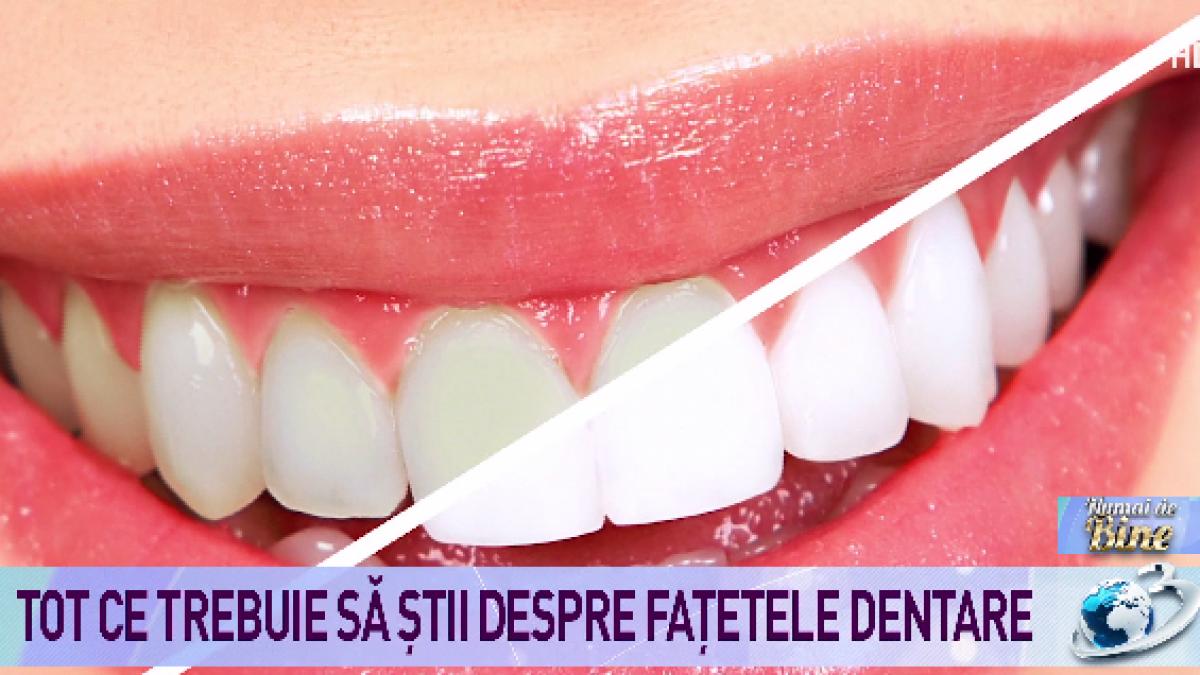 tot ce trebuie sa stii despre fatetele dentare