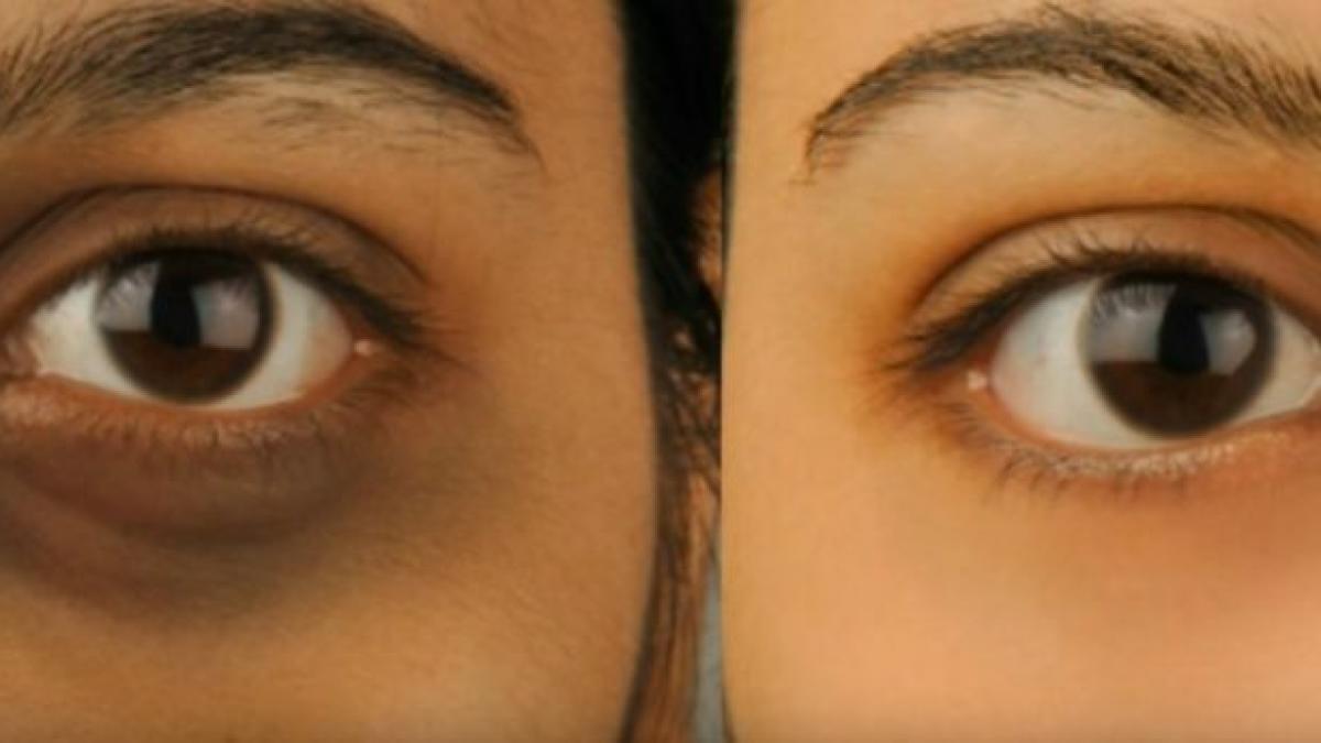 cum sa scapi de cearcane in doar trei zile trucul simplu care a functionat la milioane de femei