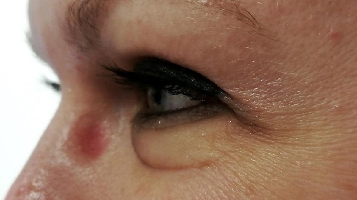 porti ochelari si ai un astfel de semn pe nas mare atentie de ce e important sa mergi la medic cat
