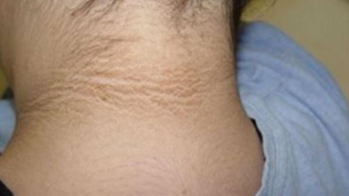 i a aparut in jurul gatului o urma ciudata si s a dus urgent la spital a fost uimita sa afle