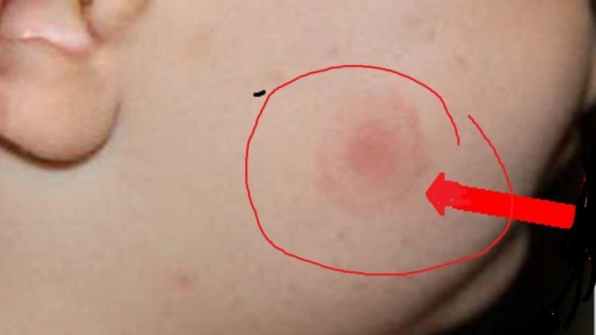 avestismentul medicilor daca observati astfel de pete pe piele trebuie sa mergeti de urgenta la