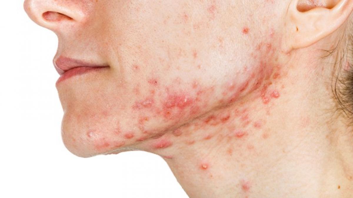 avea acnee si nu mai reusea sa scape de cosuri a facut asa ceva intr o seara si a doua zi s a