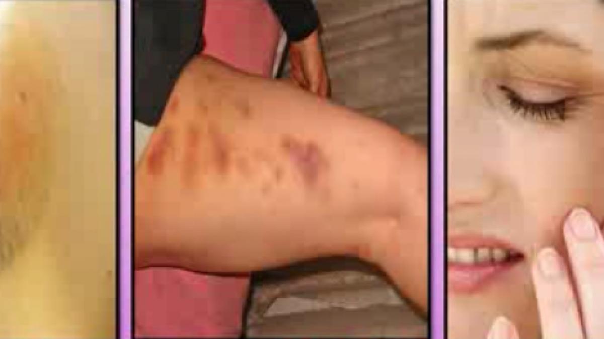 ii tot apareau vanatai pe corp si nu stia ce i se intampla ce avea de fapt in organism