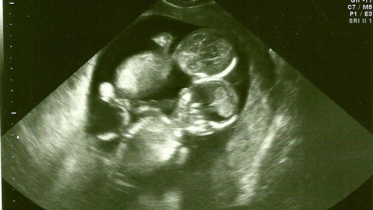 a mers la spital pentru prima ecografie cand medicul a vazut imaginea a inghetat a trimis o acasa