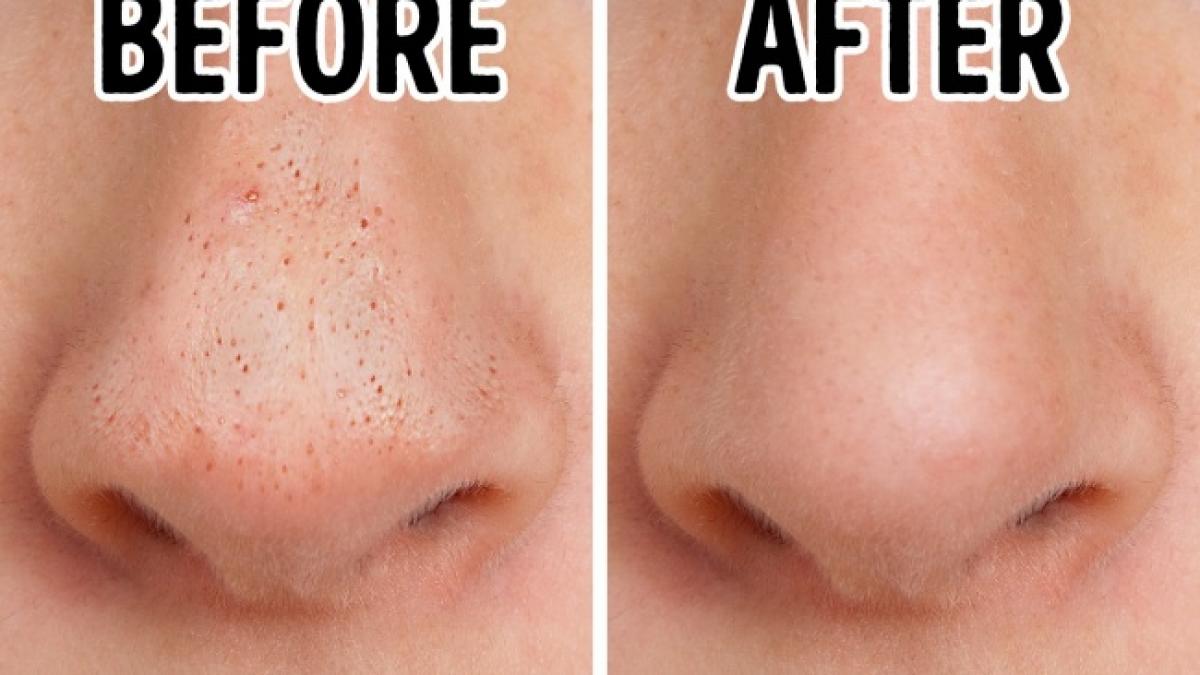 masca miraculoasa care iti scoate punctele negre si albe de pe ten de la prima utilizare o poti