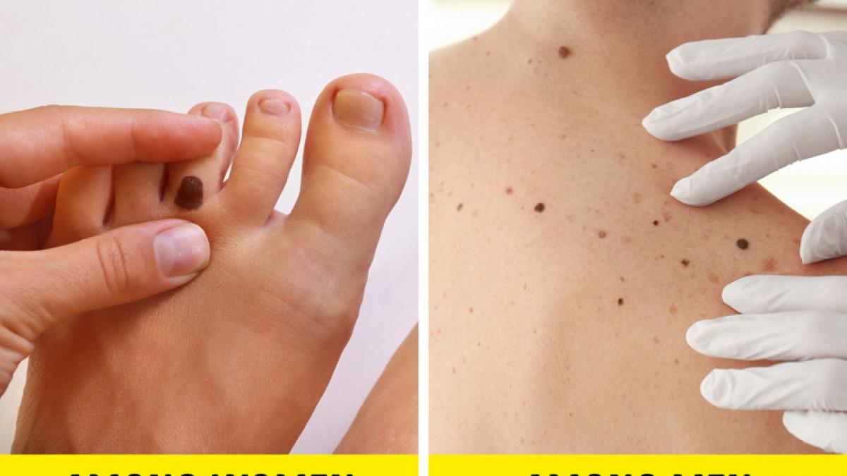 in ce zone ale corpului apare cel mai des cancerul de piele