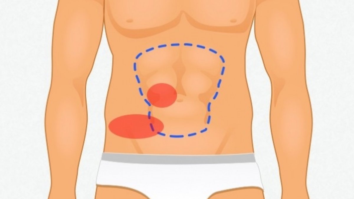Durere abdominală subombilicală (durere mai jos de buric, durerea hipogastrică)