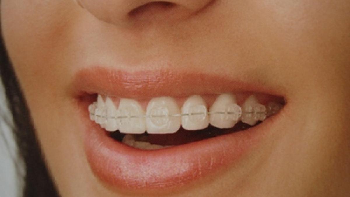 aparatul ortodontic o necesitate pentru unii un moft pentru altii