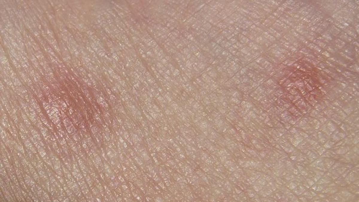 am insecte in corp pocnesc atunci cand incerc sa le scot din piele familia a incercat sa l convinga