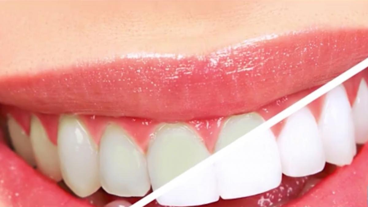 numai de bine tot ce trebuie sa stiti despre albirea dintilor mituri si adevar