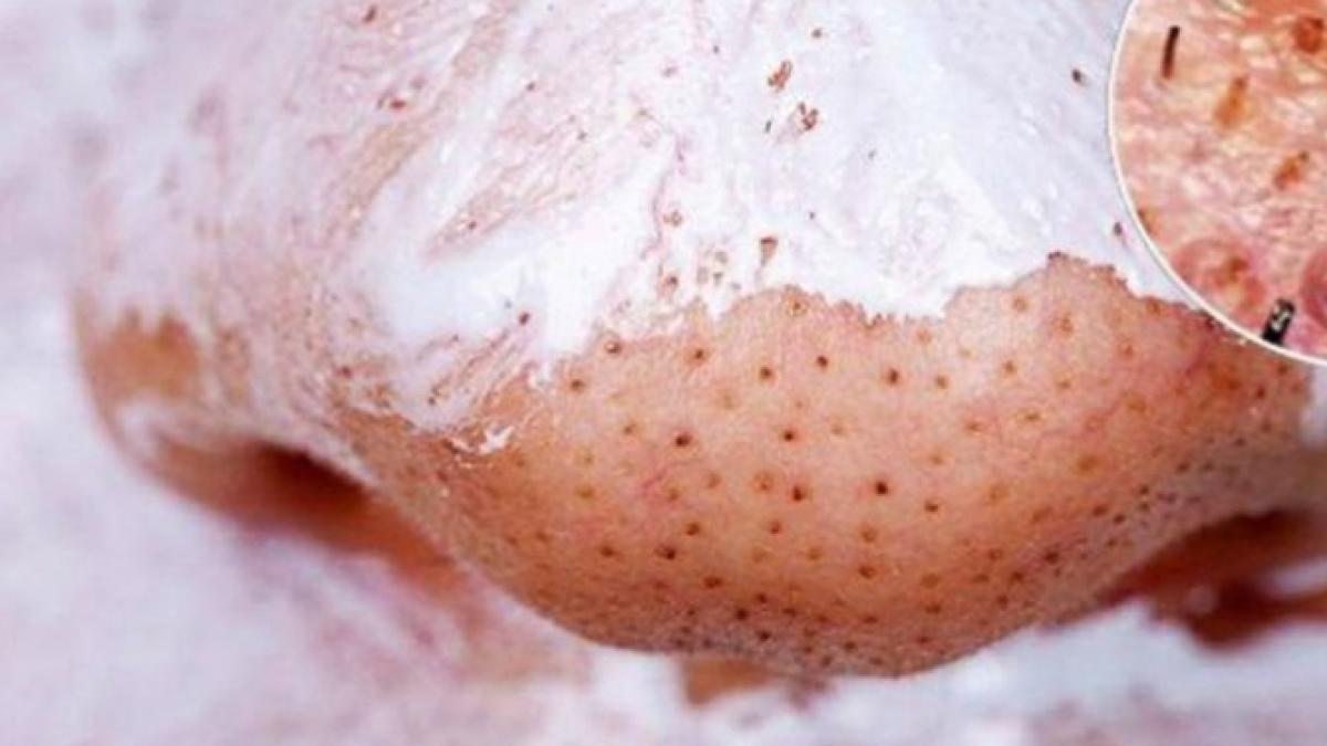 a amestecat ulei de cocos si bicarbonat de sodiu si a aplicat pe ten vei incerca si tu imediat