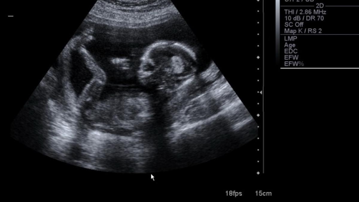 o gravida a facut dragoste in luna a saptea ce a aparut in ecografia ei cand a mers la medic