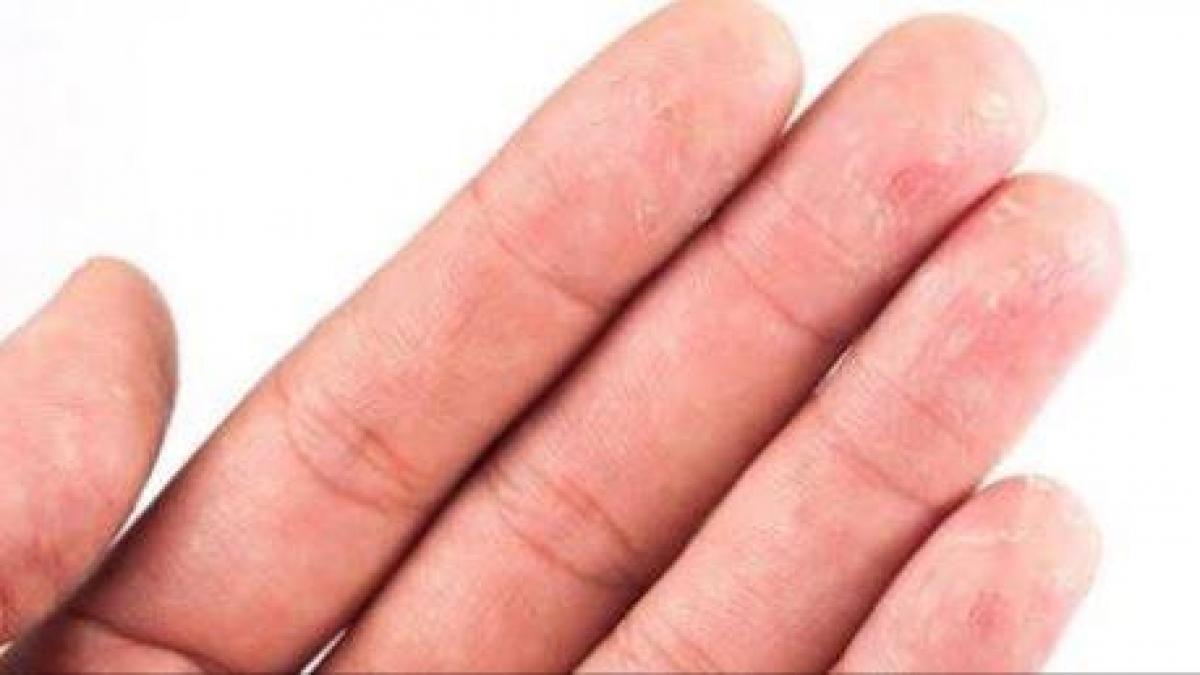 priveste ti mainile pe ele apar primele semne ale cancerului