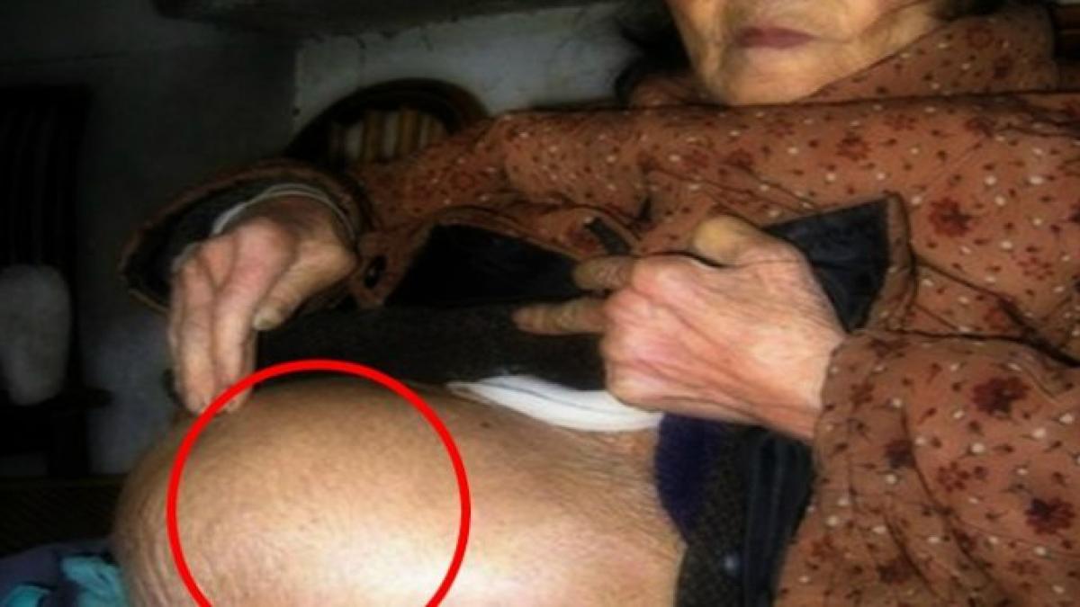 burta femeii de 92 de ani se facea tot mai mare cand au vazut ce avea acolo medicii si au facut