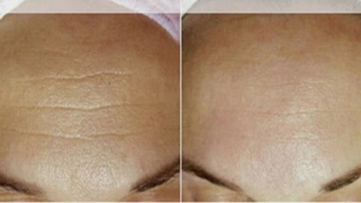 masca naturala pentru fata iritata crema anti imbatranire lorelai
