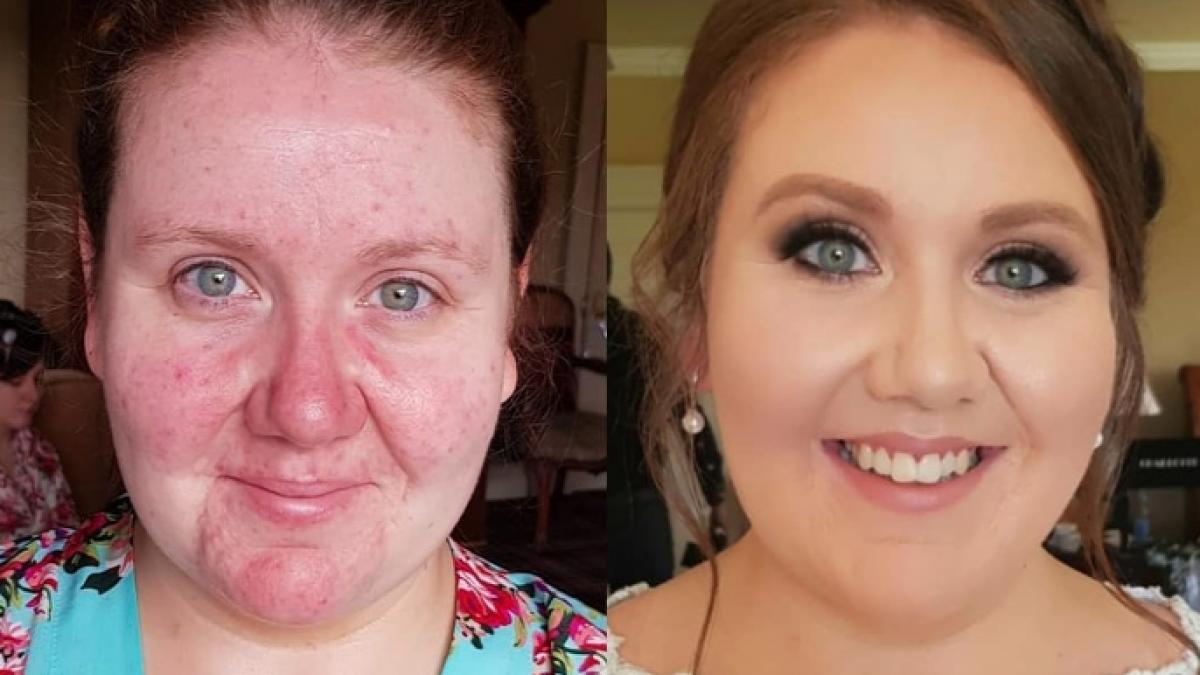 avea tenul brazdat de acnee cum a reusit aceasta tanara sa scape complet de problema care ii facea