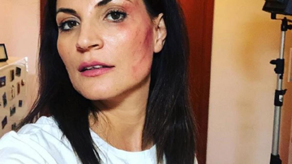 o actrita din romania cu fata plina de vanatai mi am luat o