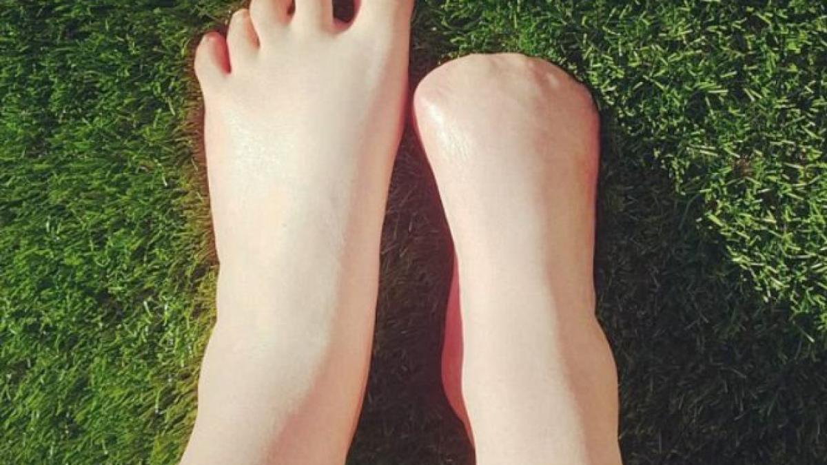 si a amputat toate degetele de la picioare dupa ce s a intors din vacanta ce bacterie a luat dintr