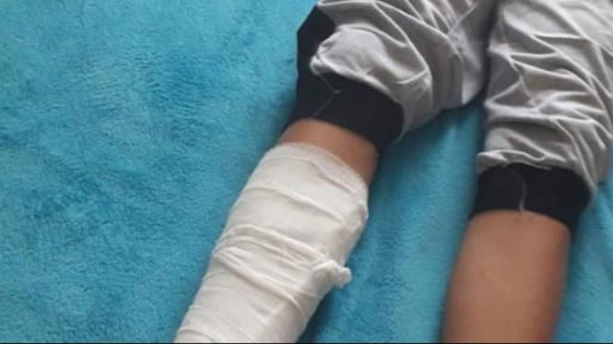 caz incredibil intr o scoala din dolj un elev si a rupt piciorul pe terenul de sport este o miriste