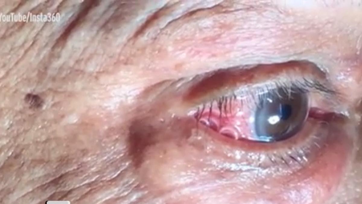 a ajuns cu dureri de ochi la spital si a fost operat de urgenta medicii au ramas socati cand au