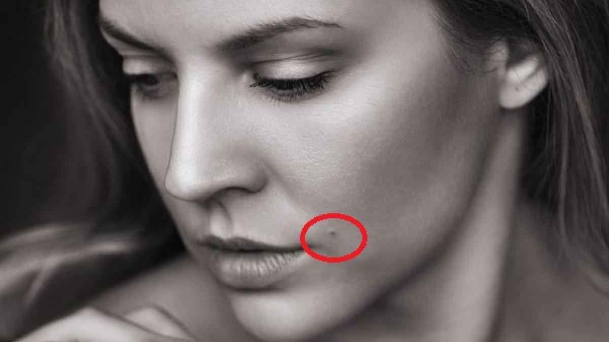 cum faci diferenta intre o alunita inofensiva si una canceroasa trebuie sa stii asta