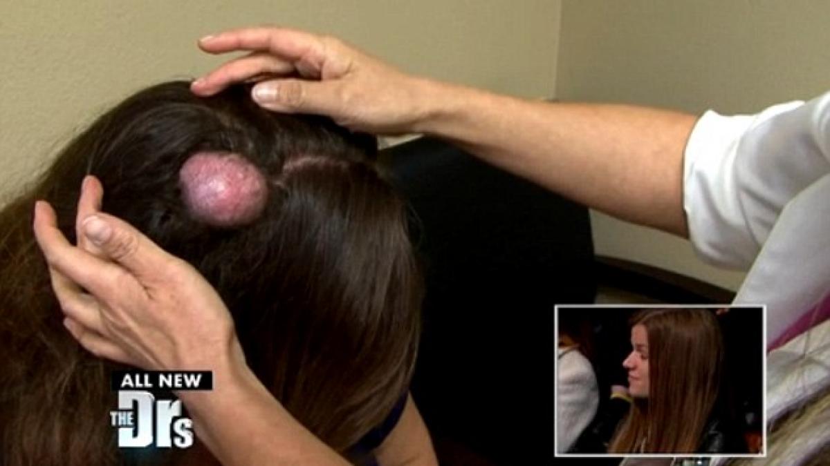 i a crescut o umflatura pe cap timp de 20 de ani medicii au fost socati cand au spart o si au vazut