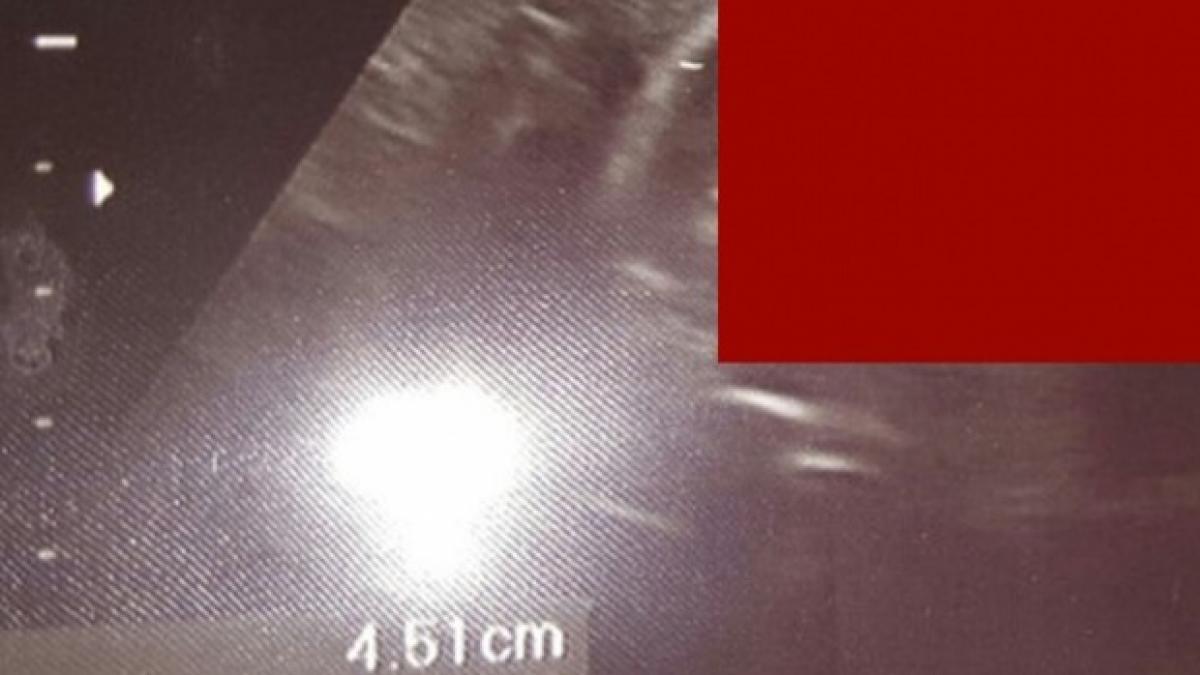 au mers la ecografie dar nu s au asteptat niciodata la asa ceva ce au vazut cand medicul le a